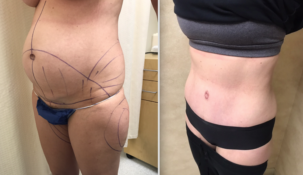 Body Contouring Along With Hernia Repair