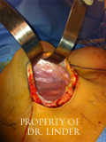Image taken during a breast revision surgery inside the breast pocket.