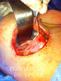 Image taken during a breast revision surgery inside the breast pocket.