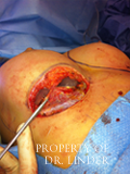 Image taken during a breast revision surgery inside the breast pocket.