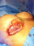 Image taken during a breast revision surgery inside the breast pocket.