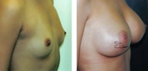 Breast Augmentation