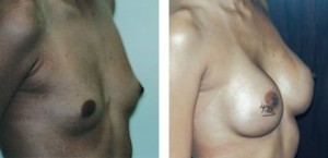 Breast Augmentation