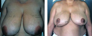 Breast Reduction