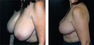 Breast Reduction