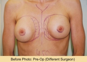 Breast Augmentation