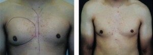 MALE BREAST REDUCTION SURGERY