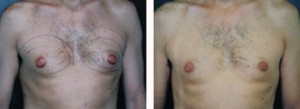 Gynecomastia