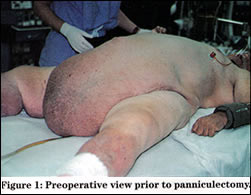 SUSPENSION TECHNIQUE FOR PANNICULECTOMY IN A MORBIDLY OBESE