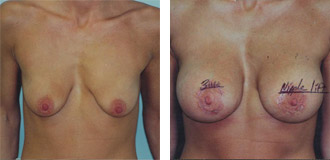 PECTUS EXCAVATUM BREAST SURGERY