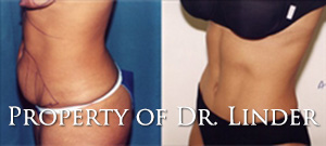 REQUIRED STEPS OF AN ABDOMINOPLASTY