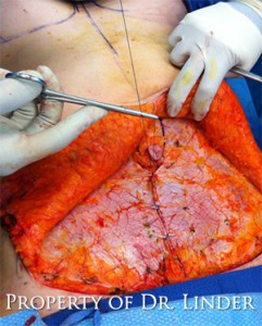 abdominoplasty03