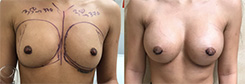 Breast Augmentation Patient Before & After Photo 1