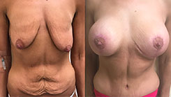 Breast Lift Patient Before & After Photo 1