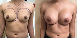 Breast Procedures Patient Before & After Photo 1