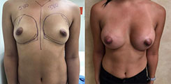 Breast Augmentation Patient Before & After Photo 1