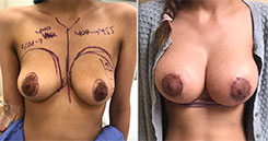 Breast Procedures Patient Before & After Photo 1