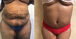 Tummy Tuck Patient Before & After Photo 1