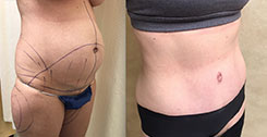 Liposuction Patient Before & After Photo 1