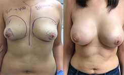 Tubular Breast Deformity Patient Before & After Photo 1