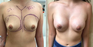 breast augmentation 325 cc