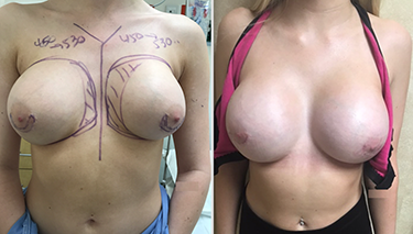 Breast Implant Revision Patient Before & After Photo 1