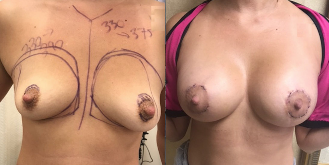 breast augmentation before and after