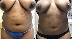 Body Procedures Patient Before & After Photo 1