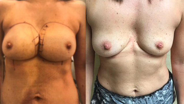 Symmastia Before and After Photos