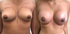 Breast Procedures Patient Before & After Photo 1