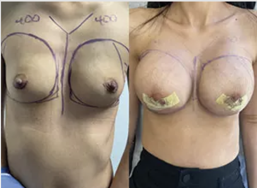 Breast augmentation before and after with 400cc implants performed in Beverly Hills