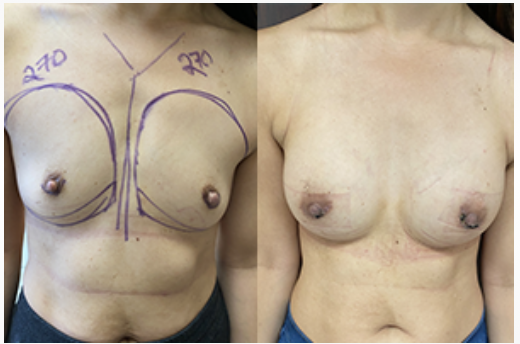 Breast augmentation before and after with 270cc implants performed in Beverly Hills.