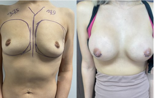 Breast augmentation before and after with 375/380cc implants performed in Beverly Hills