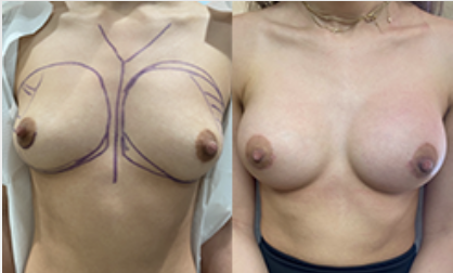 Breast augmentation before and after performed in Beverly Hills