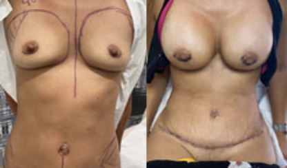 Breast augmentation before and after performed in Beverly Hills