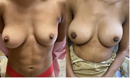 Breast augmentation before and after performed in Beverly Hills, CA