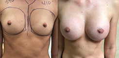 Breast Procedures Patient Before & After Photo 1