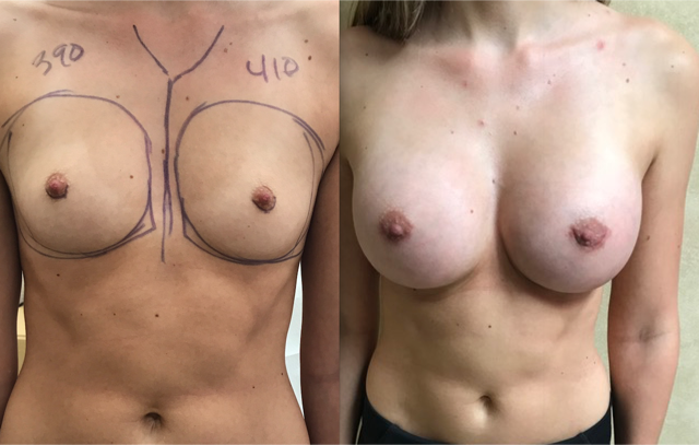 Breast Augmentation Is a Very Gratifying Procedure