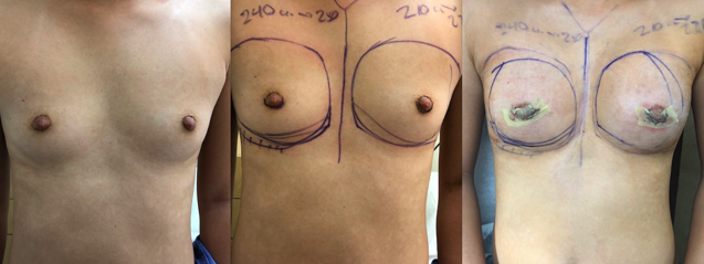 Breast Augmentation Before and After Photos