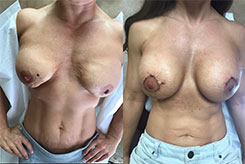 Breast Revision Before And After Photos - patient 5