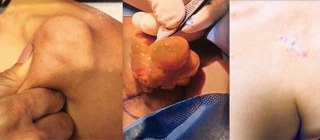 Tumor Removal Before and After Photos