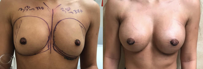 Breast Augmentation Before and After Photos