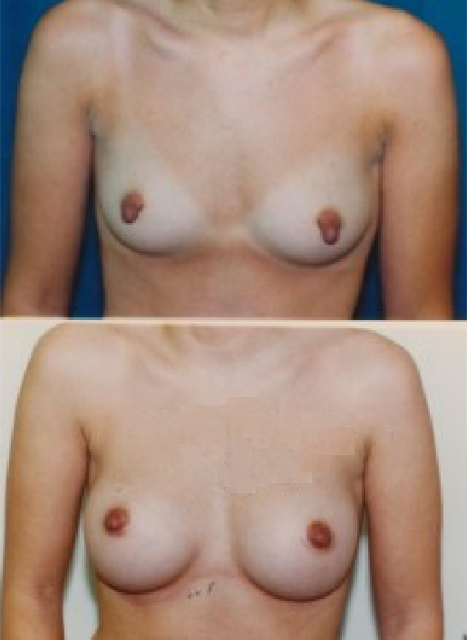 Nipple Hypertrophy Correction Before and After Photo Two