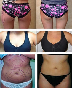 Liposuction Before and After Photos