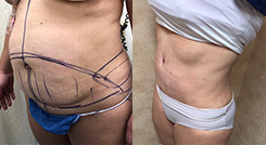 Liposuction Patient Before & After Photo 1