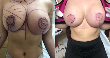 Breast Implant Revision Patient Before & After Photo 1