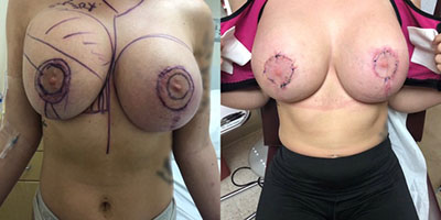 Before and After Breast Revision - Patient 3