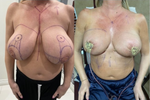 Before and after image of a breast reduction in Beverly Hills. Patient went from F-cup to D-cup.