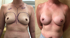 Breast Procedures Patient Before & After Photo 1