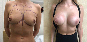 Breast Augmentation Patient Before & After Photo 1